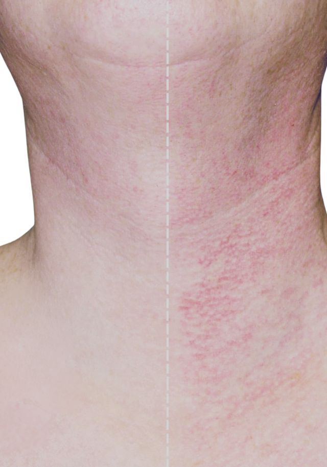 Rosacea Therapy