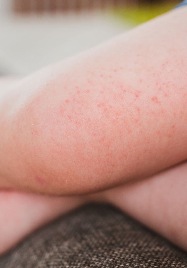 Allergic Skin Reactions & Rashes