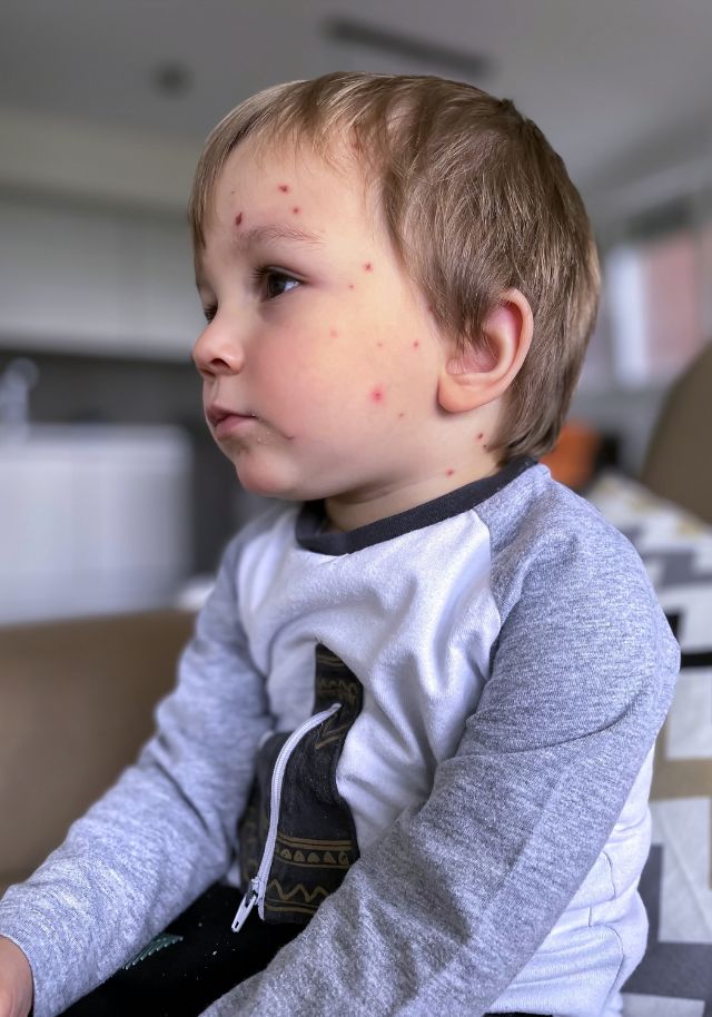 Acne & Breakout Management