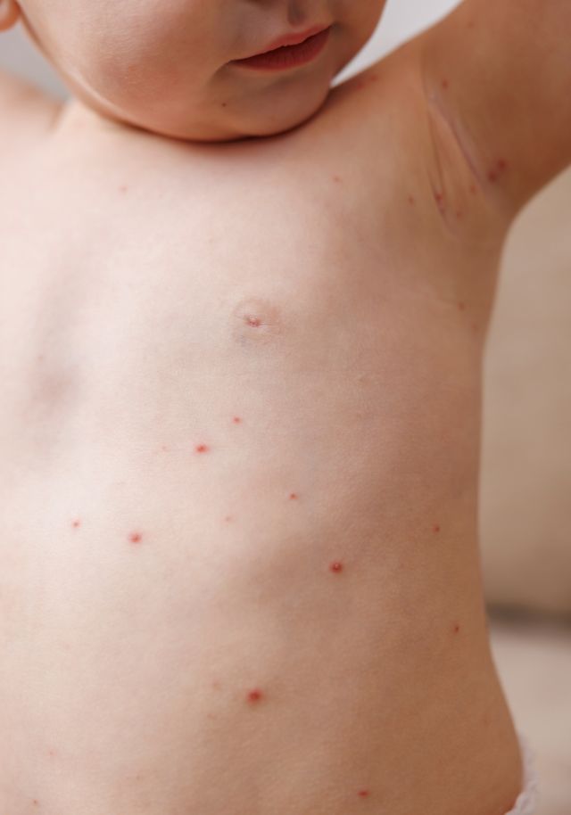 Wart & Molluscum Removal