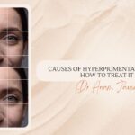 causes of hyperpigmentation and how to treat it