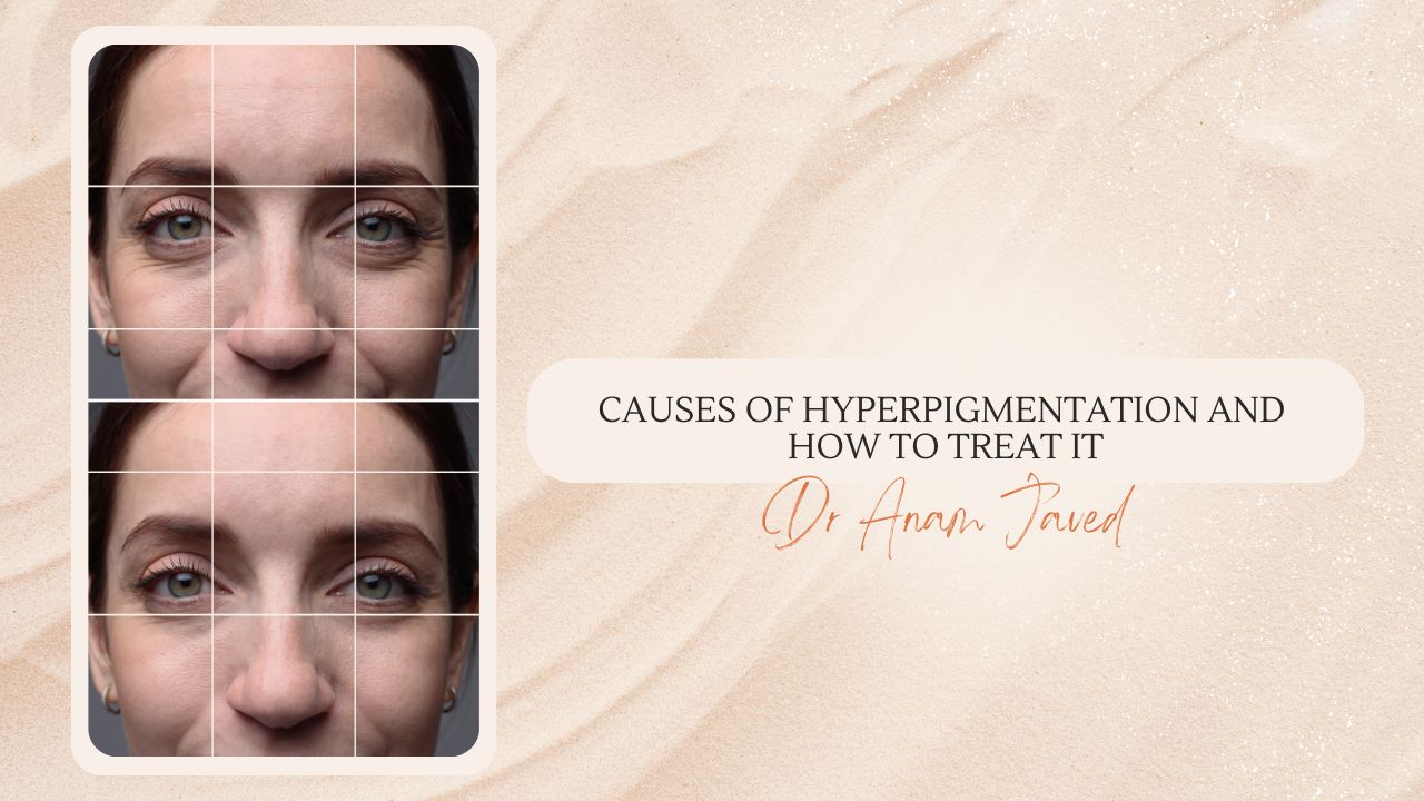 causes of hyperpigmentation and how to treat it