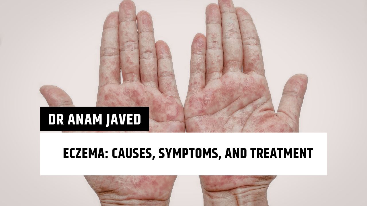 Eczema