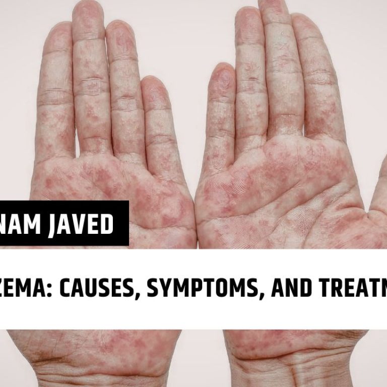 Eczema