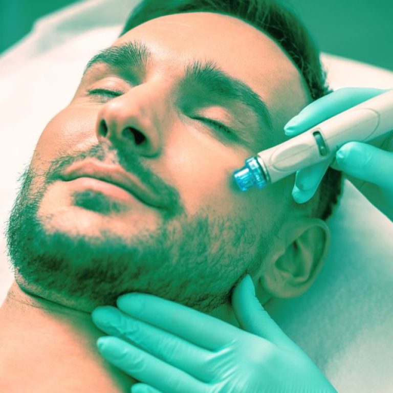 Laser Skin Resurfacing