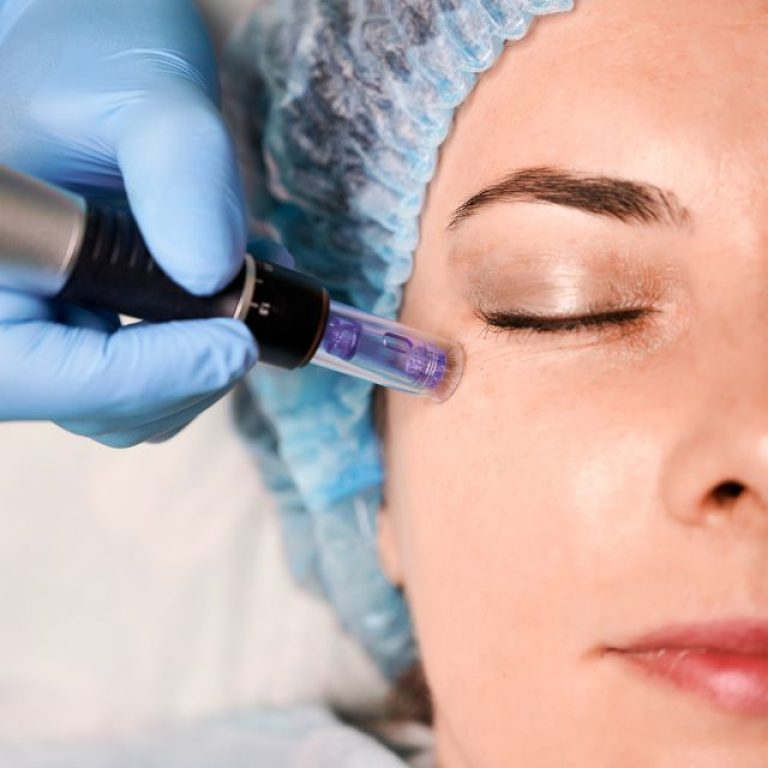 Micro needling