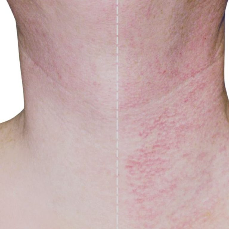 Rosacea Therapy